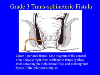 Imaging of Anal Fistulae and perianal abscesses | PPT