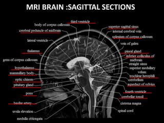 MRI BRAIN :SAGITTAL SECTIONS
 