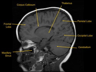 Frontal
Lobe
Maxillary
Sinus
Parietal Lobe
Occipital Lobe
Corpus Callosum
Thalamus
Cerebellum
 