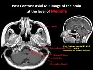Post Contrast Axial MR Image of the brain
at the level of Medulla
 