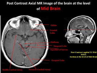 Post Contrast Axial MR Image of the brain at the level
of Mid Brain
 