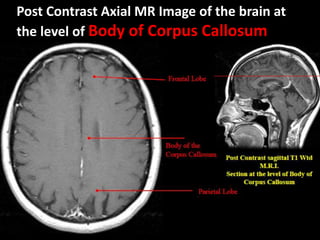 Post Contrast Axial MR Image of the brain at
the level of Body of Corpus Callosum
 