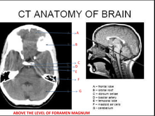 A
B
C
D
E
F
G
ABOVE THE LEVEL OF FORAMEN MAGNUM
 