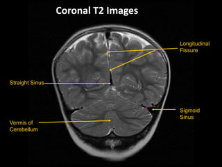 Longitudinal
Fissure
Sigmoid
Sinus
Straight Sinus
Vermis of
Cerebellum
Coronal T2 Images
 