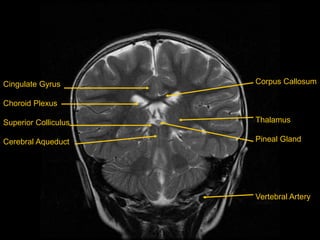 Cingulate Gyrus
Choroid Plexus
Superior Colliculus
Cerebral Aqueduct
Corpus Callosum
Thalamus
Pineal Gland
Vertebral Artery
 