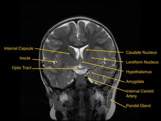 Internal Capsule
Insula
Optic Tract
Caudate Nucleus
Lentiform Nucleus
Hypothalamus
Amygdala
Internal Carotid
Artery
Parotid Gland
 