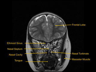 Ethmoid Sinus
Nasal Septum
Nasal Cavity
Tongue
Frontal Lobe
Nasal Turbinate
Masseter Muscle
 