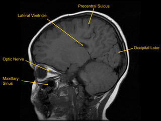 Optic Nerve
Maxillary
Sinus
Precentral Sulcus
Lateral Ventricle
Occipital Lobe
 