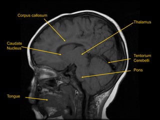 Caudate
Nucleus
Tongue
Corpus callosum
Thalamus
Tentorium
Cerebelli
Pons
 