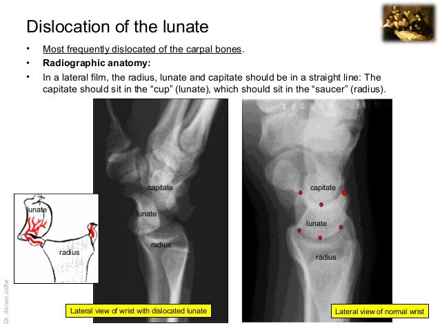 Imaging anatomy dislocation of the lunate