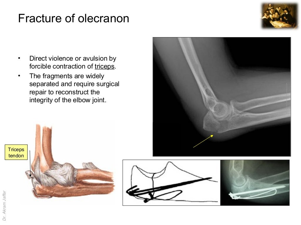 left olecranon fracture left olecranon fracture