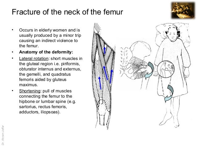 Femur Fracture Anatomy
