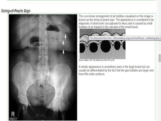 Small Intestine String. Sign Imaging anatomy of small intestine | PPTX