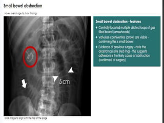 Small Intestine String. Sign Imaging anatomy of small intestine | PPTX