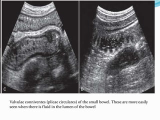 Valvulae Imaging anatomy of small intestine | PPTX