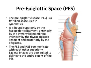 MR imaging, larynx. Preepiglottic space (P) is hyperintense secondary to fat.
 