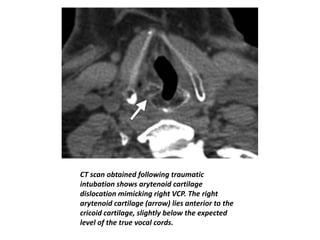 Unenhanced axial CT image shows
supraglottic hemangioma (arrow).
B, Contrast-enhanced axial image
(B) show soft-tissue mas...