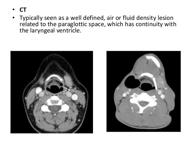Which Condition Causes A Steeple Sign On X-ray? Imaging and pathology of larynx (2)