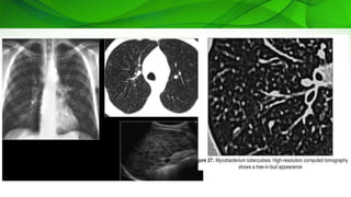 Imaging approach to common respiratory infections in immuno-compromised ...