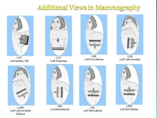 Mammogram Slides Imaging breast mammogram | PPT
