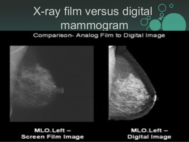 imaging breast mammogram