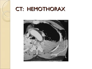 Imaging chest trauma | PPT