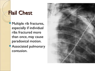 Imaging chest trauma | PPT