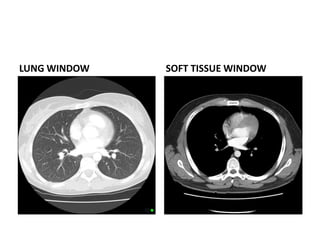 LUNG WINDOW SOFT TISSUE WINDOW
 