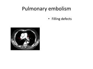 Pulmonary embolism
• Filling defects
 