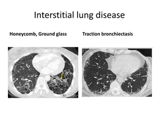 Interstitial lung disease
Honeycomb, Ground glass Traction bronchiectasis
 