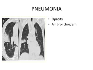 PNEUMONIA
• Opacity
• Air bronchogram
 