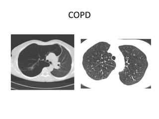 COPD
 