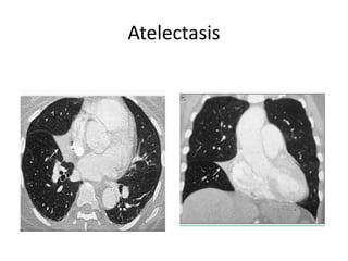 Atelectasis
 