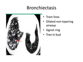 Bronchiectasis
• Tram lines
• Dilated non-tapering
airways
• Signet ring
• Tree in bud
 