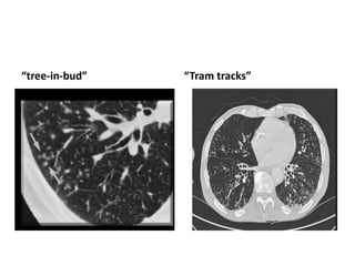 “tree-in-bud” “Tram tracks”
 