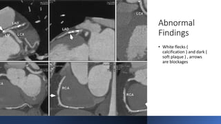 Abnormal
Findings
• White flecks (
calcification ) and dark (
soft plaque ) , arrows
are blockages
 