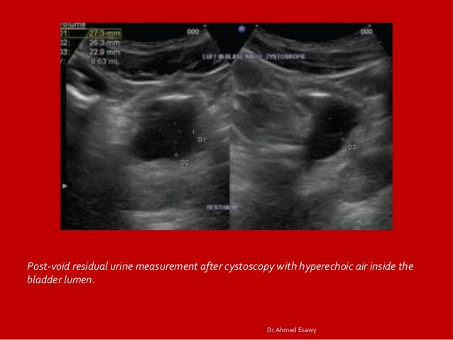 cpt code for post void bladder scan