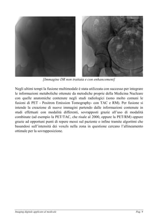 Imaging digitale applicato al medicale Pag. 9
[Immagine DR non trattata e con enhancement]
Negli ultimi tempi la fusione multimodale è stata utilizzata con successo per integrare
le informazioni metaboliche ottenute da metodiche proprie della Medicina Nucleare
con quelle anatomiche contenute negli studi radiologici (sono molto comuni le
fusioni di PET - Positron Emission Tomography- con TAC e RM). Per fusione si
intende la creazione di nuove immagini partendo dalle informazioni contenute in
studi effettuati con modalità differenti, sovrapposti grazie all’uso di modalità
combinate (ad esempio la PET/TAC, che risale al 2000, oppure la PET/RM) oppure
grazie ad opportuni punti di repere messi sul paziente o infine tramite algoritmi che
basandosi sull’intensità dei voxels nella zona in questione cercano l’allineamento
ottimale per la sovrapposizione.
 