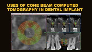 USES OF CONE BEAM COMPUTED
TOMOGRAPHY IN DENTAL IMPLANT
 