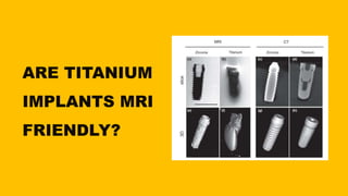 ARE TITANIUM
IMPLANTS MRI
FRIENDLY?
 