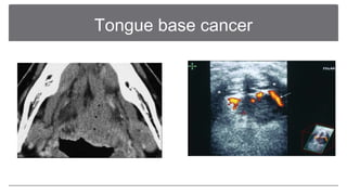 Imaging for the oral cavity neoplastic lesions final | PPT
