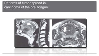 Imaging for the oral cavity neoplastic lesions final | PPT