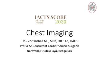Chest Imaging
Dr S.V.Srikrishna MS, MCh, FRCS Ed, FIACS
Prof & Sr Consultant Cardiothoracic Surgeon
Narayana Hrudayalaya, Bengaluru
 