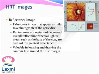HRT Images
 Reflectance Image
 False-color image that appears similar
to a photograph of the optic disc
 Darker areas are regions of decreased
overall reflectance, whereas lighter
areas, such as the base of the cup, are
areas of the greatest reflectance
 Valuable in locating and drawing the
contour line around the disc margin
 