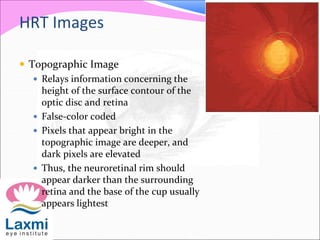 HRT Images
 Topographic Image
 Relays information concerning the
height of the surface contour of the
optic disc and retina
 False-color coded
 Pixels that appear bright in the
topographic image are deeper, and
dark pixels are elevated
 Thus, the neuroretinal rim should
appear darker than the surrounding
retina and the base of the cup usually
appears lightest
 