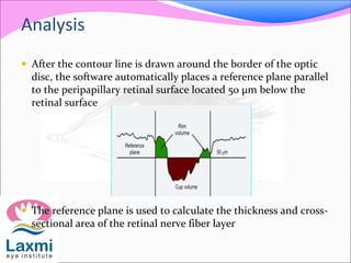 Analysis
 After the contour line is drawn around the border of the optic
disc, the software automatically places a reference plane parallel
to the peripapillary retinal surface located 50 μm below the
retinal surface
 The reference plane is used to calculate the thickness and cross-
sectional area of the retinal nerve fiber layer
 
