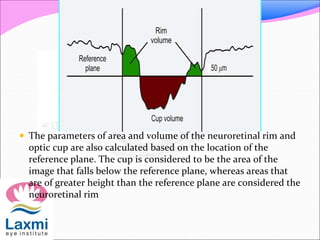  The parameters of area and volume of the neuroretinal rim and
optic cup are also calculated based on the location of the
reference plane. The cup is considered to be the area of the
image that falls below the reference plane, whereas areas that
are of greater height than the reference plane are considered the
neuroretinal rim
 