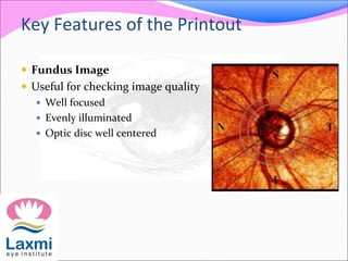 Key Features of the Printout
 Fundus Image
 Useful for checking image quality
 Well focused
 Evenly illuminated
 Optic disc well centered
 