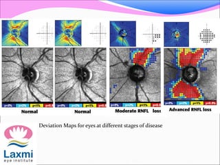 Deviation Maps for eyes at different stages of disease
 