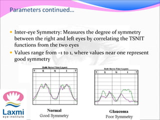 Parameters continued…
 Inter-eye Symmetry: Measures the degree of symmetry
between the right and left eyes by correlating the TSNIT
functions from the two eyes
 Values range from –1 to 1, where values near one represent
good symmetry
 